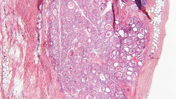 Overgewicht en de TyG-index als voorspellers van sterfte bij diabetes type 2